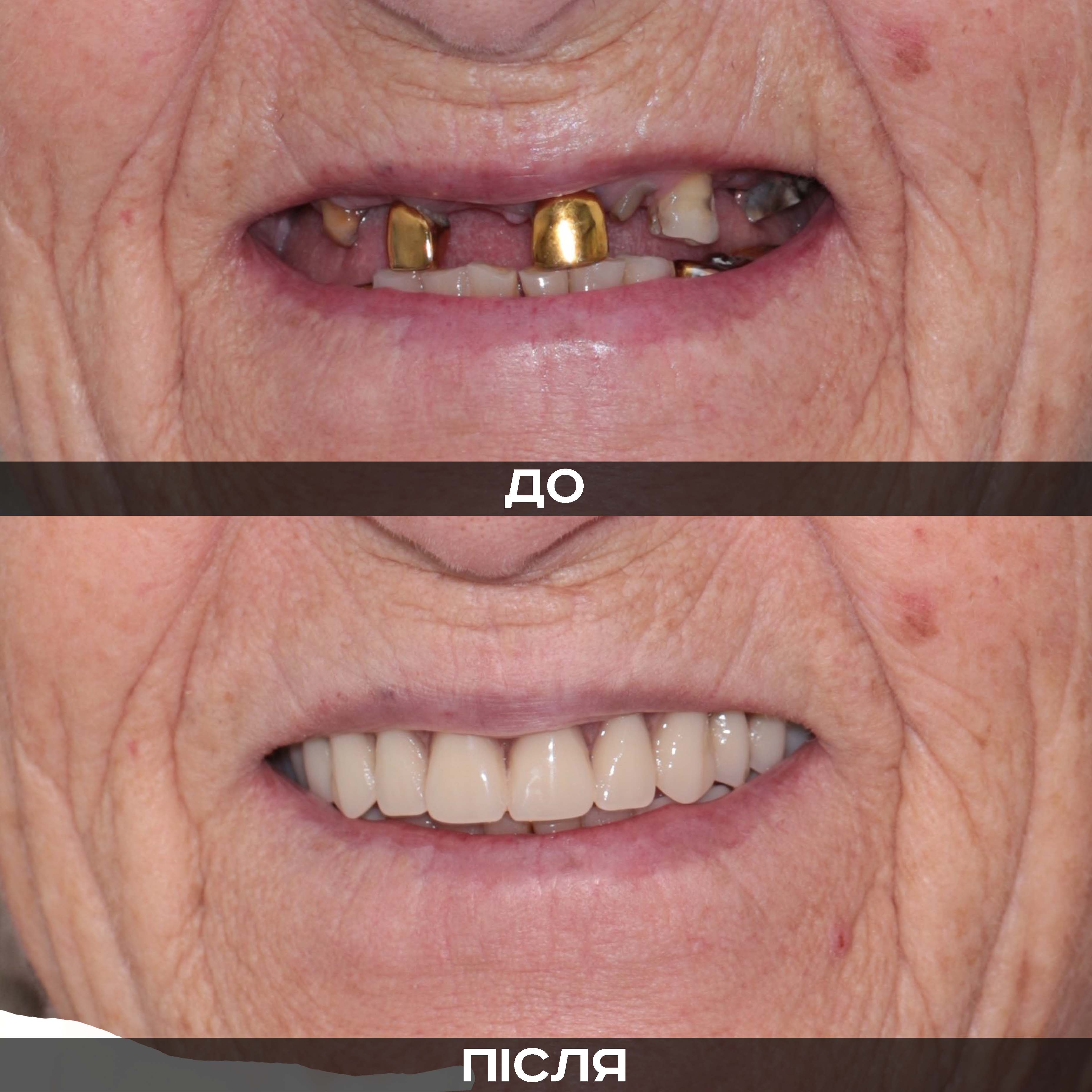 Реставрація керамічними накладками. Кейс 9